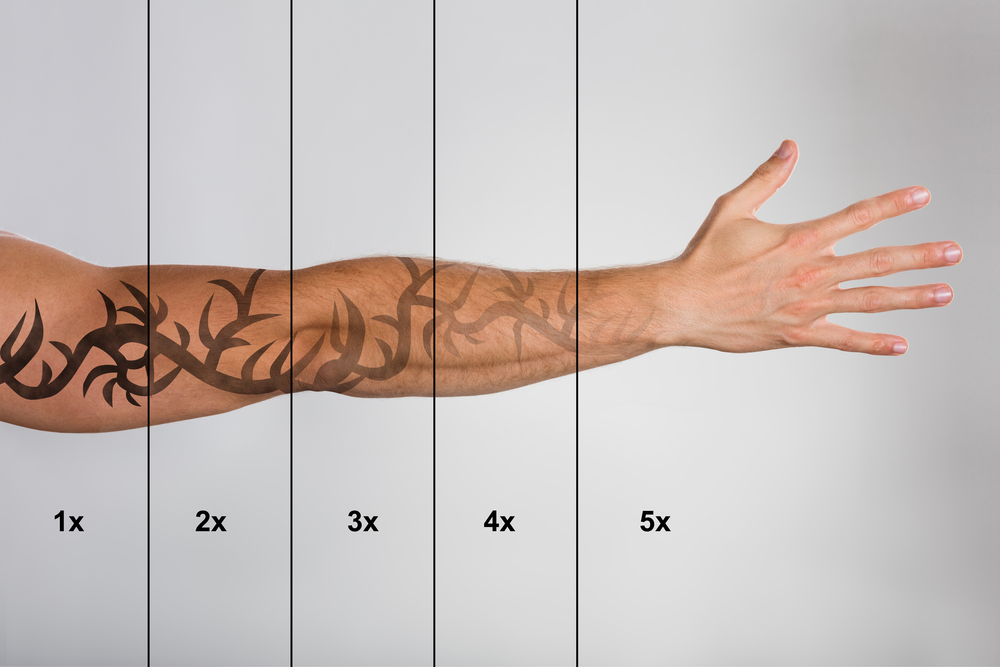 How Long Does Laser Tattoo Removal Take? | Bala Aesthetics