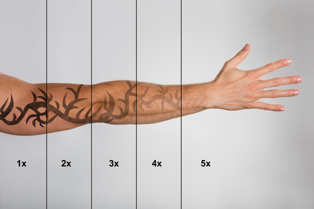 How Long Does Laser Tattoo Removal Take? Bala Aesthetics