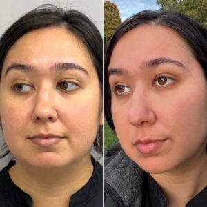 Rejuvenate Microneedling with PDRN