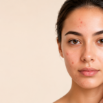 Why Acne Treatment Must Address Both Internal & External Scars_Bala Med Spa