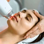 Laser Skin Resurfacing VS Microneedling: Which Treatment Is Better?_Bala Medi Spa