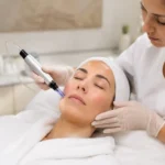 How many microneedling sessions do you need? Microneedling treatment in Bel Air MD