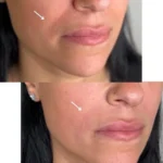 Botox Vs Fillers For Smile Lines: Which Treatment May Help?_Bala Aesthetics & Medispa