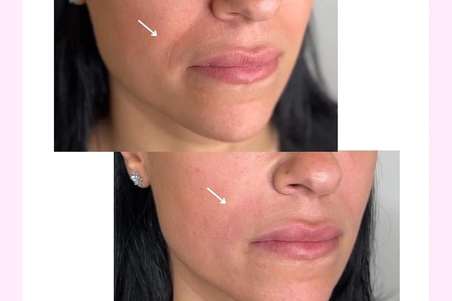Botox Vs Fillers For Smile Lines: Which Treatment May Help?_Bala Aesthetics & Medispa