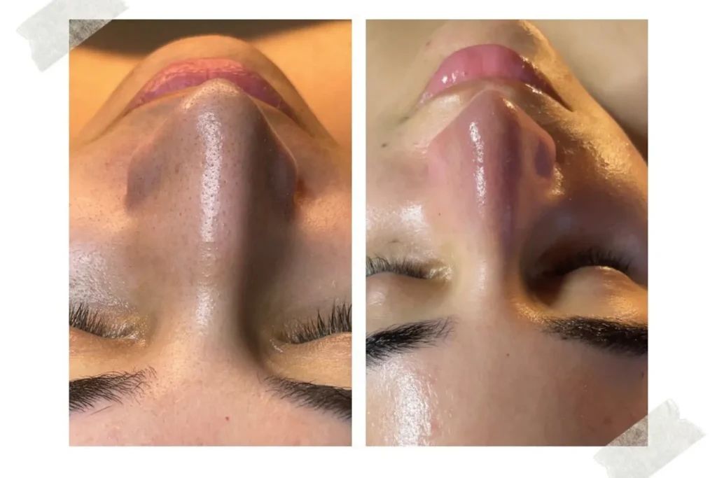 Thinking About A HydraFacial In Bel Air, MD? Benefits, Care & Aftercare _Bala Aesthetics & Medispa