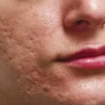 How Many Treatments Does It Take to Improve Acne Scars?_Bala Aesthetics & Medispa