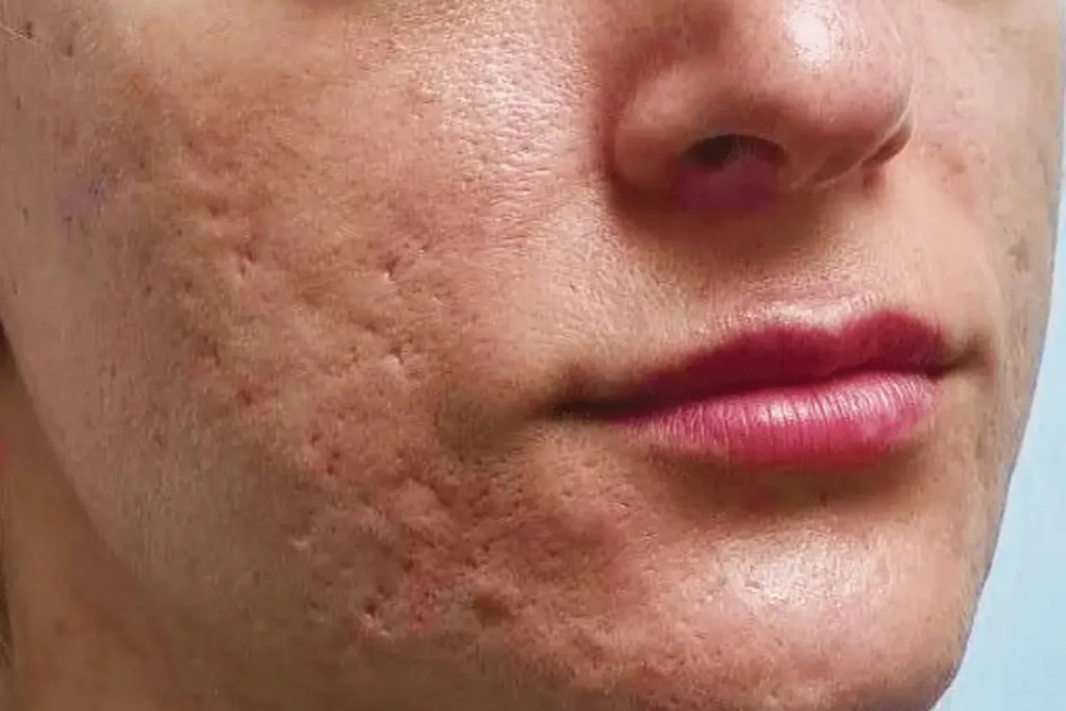 How Many Treatments Does It Take to Improve Acne Scars?_Bala Aesthetics & Medispa