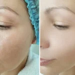 Microneedling Vs Laser Resurfacing_Bala Aesthetics & Medispa