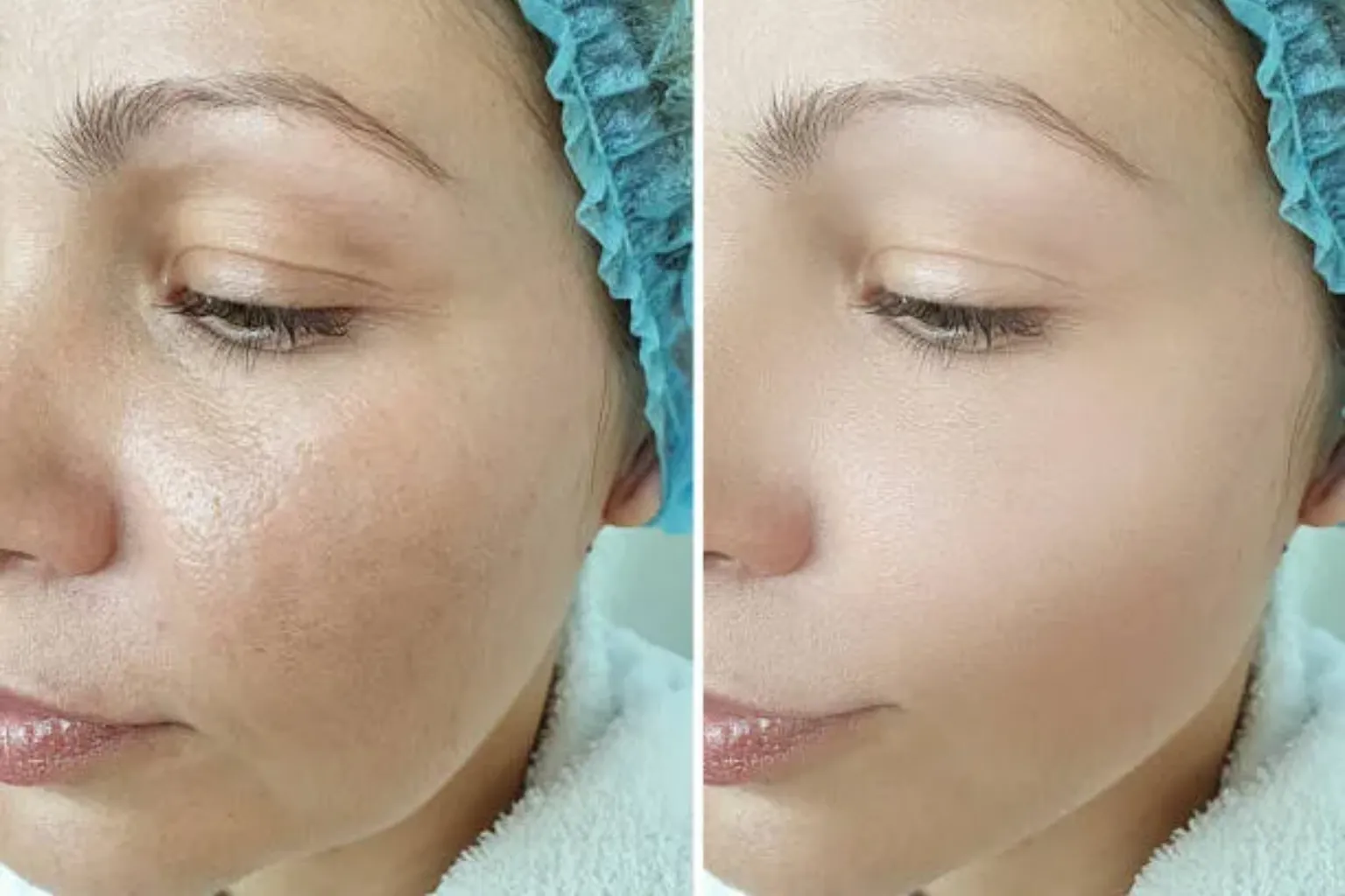 Microneedling Vs Laser Resurfacing_Bala Aesthetics & Medispa