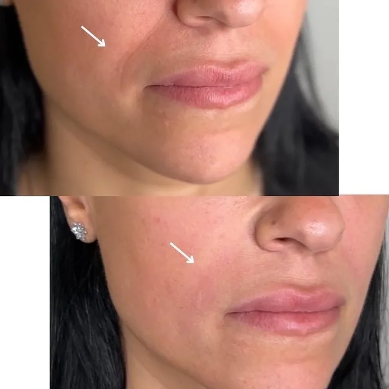 Botox Vs Fillers For Smile Lines: Which Treatment May Help?_Bala Aesthetics & Medispa