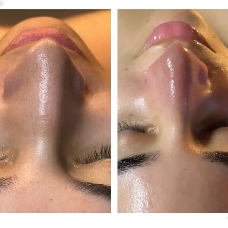 Thinking About A HydraFacial In Bel Air, MD? Benefits, Care & Aftercare _Bala Aesthetics & Medispa