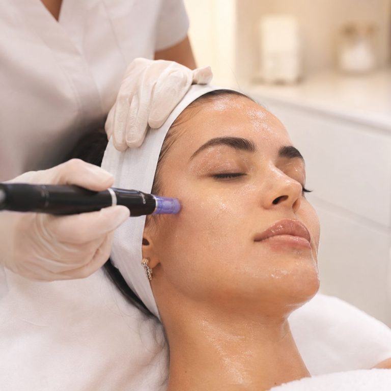 Microneedling with PDRN for summer skin maintenance to support collagen production and healthy glowing skin